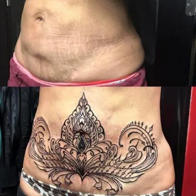 Tummy Scar cover up