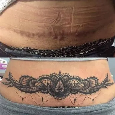 Tummy scar tattoo